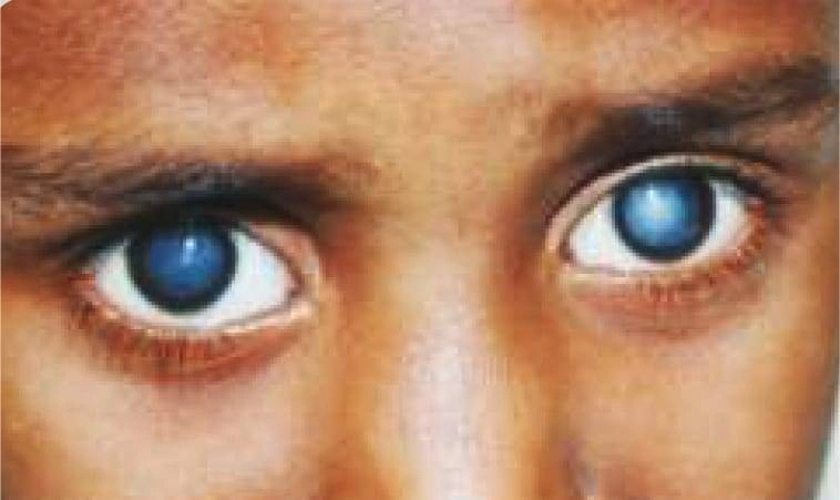 Childhood Cataract