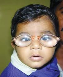 Treatment of Cataract in Children